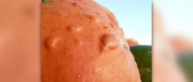 Symptoms of verruca