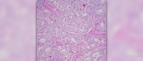Symptoms of zollinger-ellison syndrome