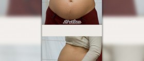 Tailbone pain during pregnancy