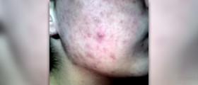 Teenage acne: is there a cure ?
