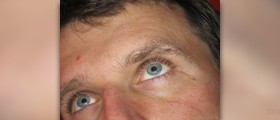 Testosterone replacement therapy
