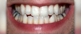 The best home teeth whitener