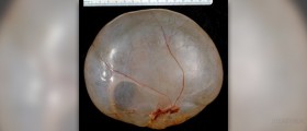 The MENACES of a painful ovarian cyst