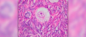 The real causes that lead to the formation of ovarian cysts