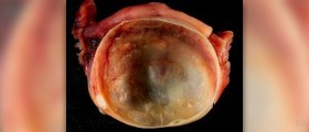 The right way to ovarian cyst management