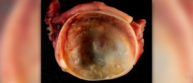 The true causes of ovarian cysts