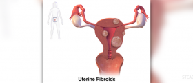 The true cost of uterine fibroids?