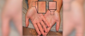 Therapy for carpal tunnel