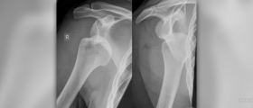 Therapy for dislocated shoulder