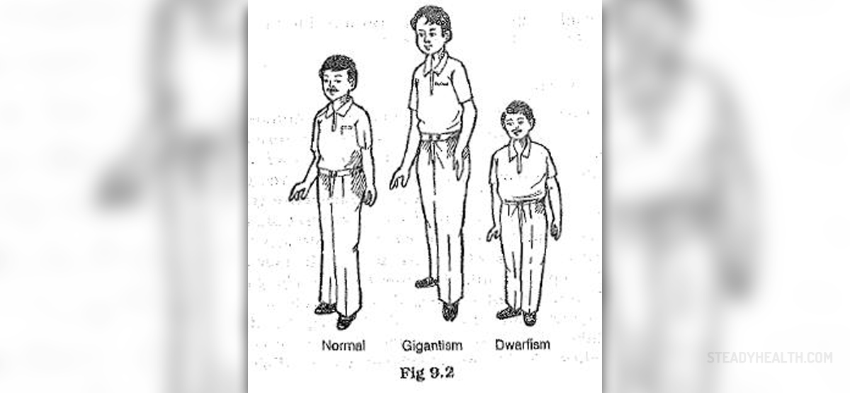 Therapy For Gigantism | Body & Health Conditions Center | SteadyHealth.com