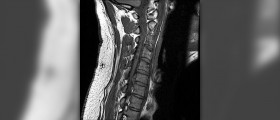 Therapy for herniated cervical disc