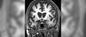 Therapy for Huntington's disease