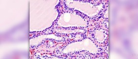 Therapy for hyperthyroidism