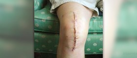 Therapy for patellofemoral syndrome