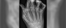 Therapy for rheumatoid arthritis