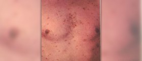 Therapy for syphilis