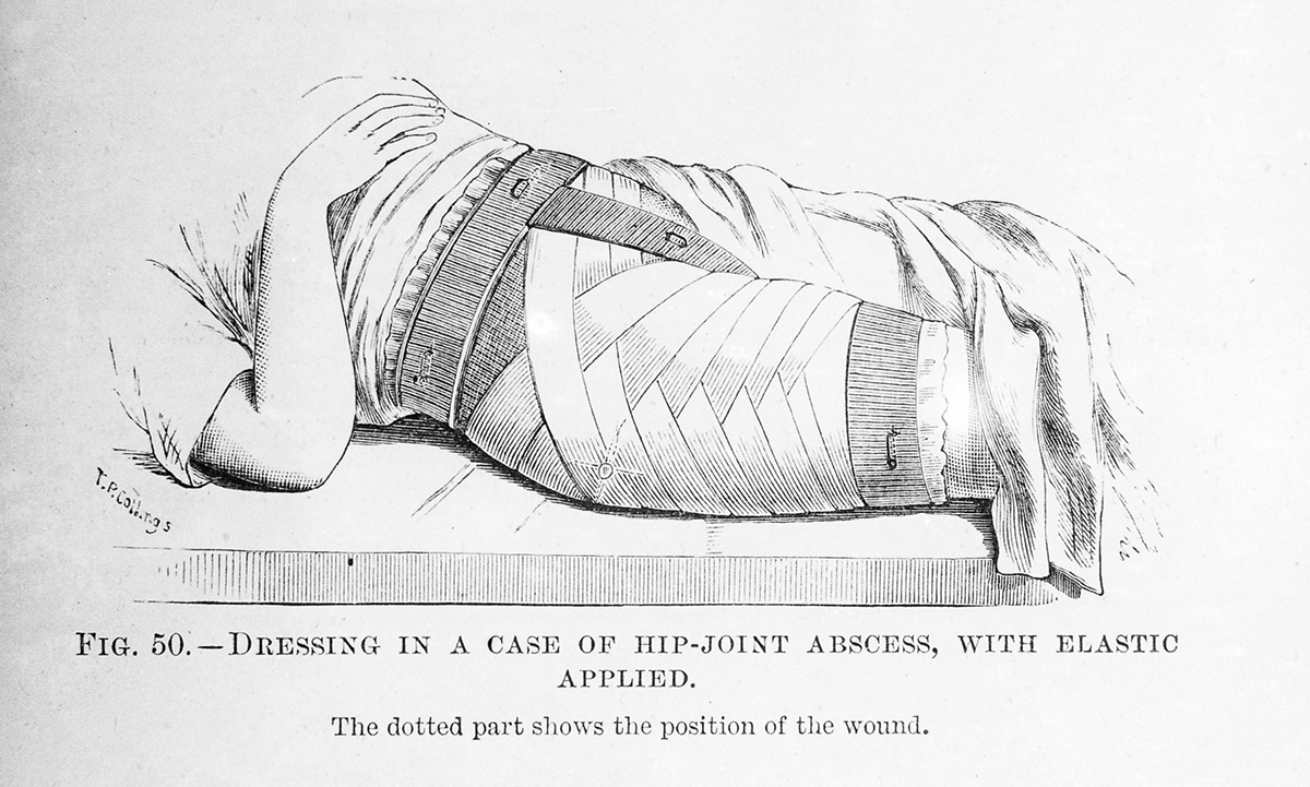 Inner Thigh Pain After Hip Replacement