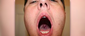 Throat inflammation facts