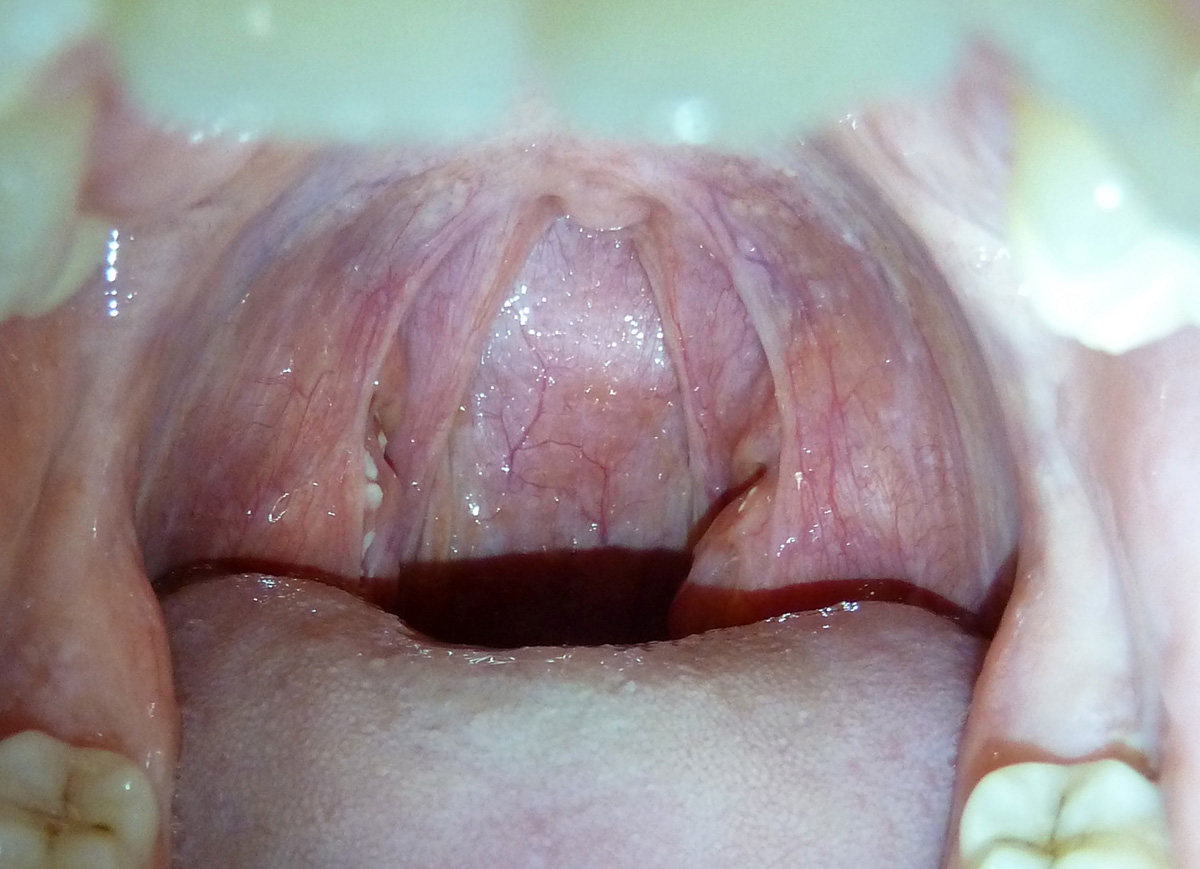 White spots on throat | General center | SteadyHealth.com