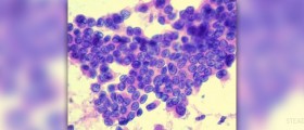 Thyroid cancer symptoms in women