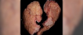 Thyroid test: TSH blood test