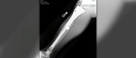 Tibia fracture surgery