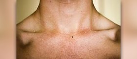 Tighten neck skin