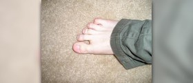Toe cramps cause