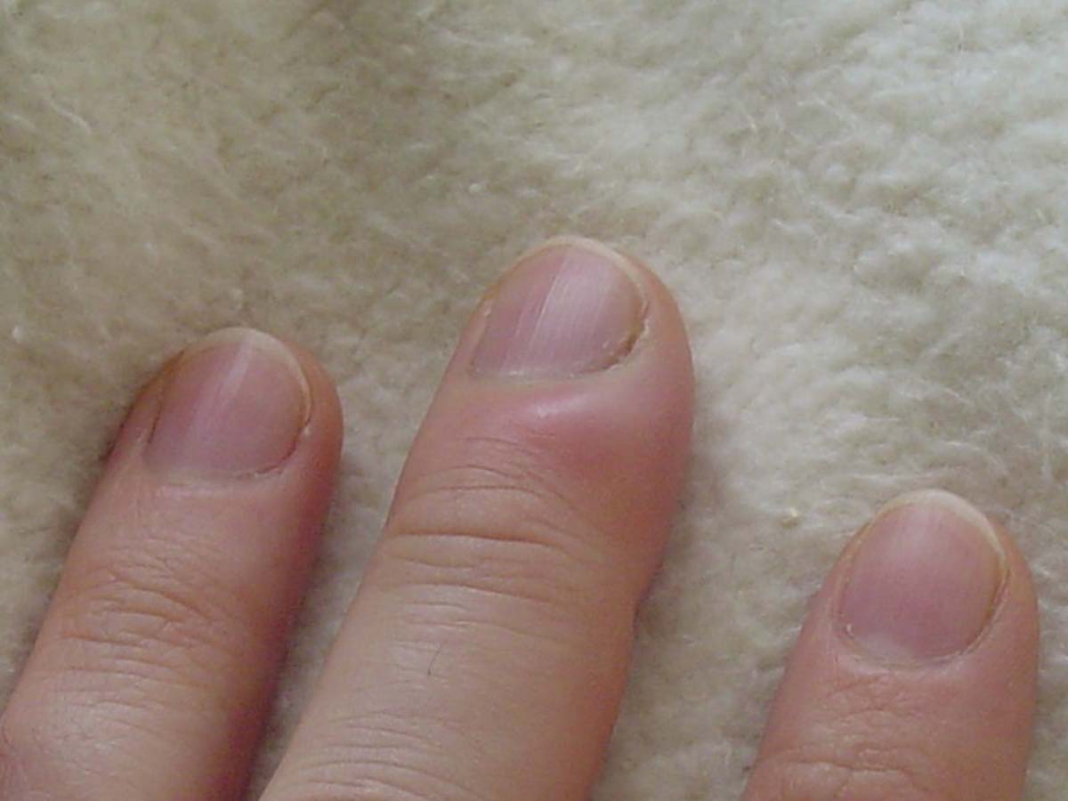 Toenail fungus signs | General center | SteadyHealth.com