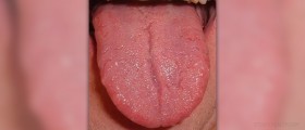 Tongue cancer treatment