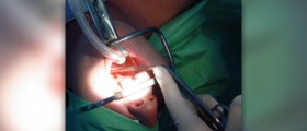 Tonsil stones treatment - how do you cure tonsil stones?