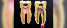 Tooth abscess review