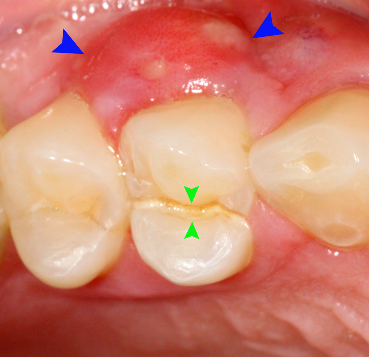 Complications of tooth abscess | General center | SteadyHealth.com