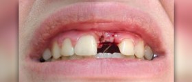 Tooth implant cost