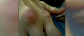 Tophi gout treatment will improve
