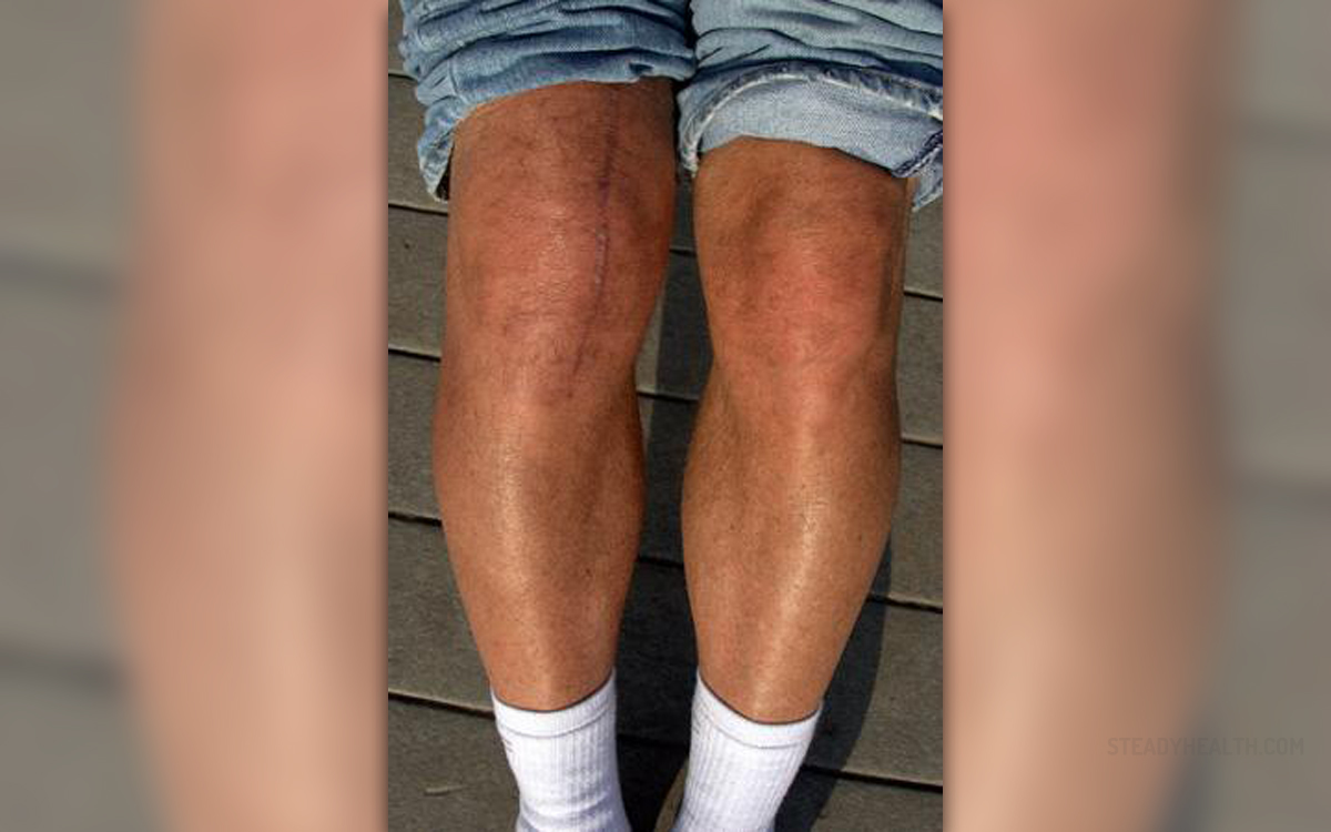 How Is Torn Knee Cartilage Repair