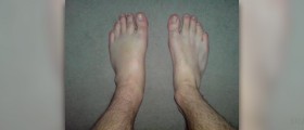 Torn ligament in ankle