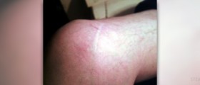 Torn meniscus treatment