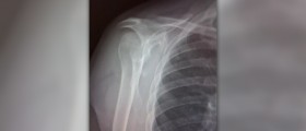 Torn rotator cuff symptoms