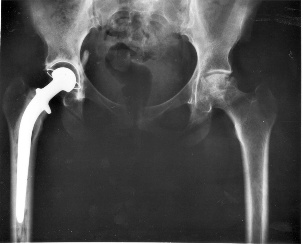Total hip replacement procedure | Musculoskeletal Issues articles