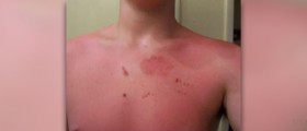 Treating second degree burns