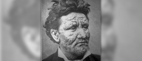 Treatment and care for leprosy