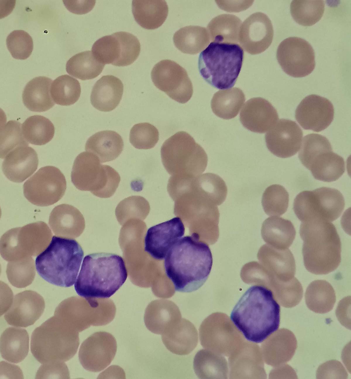 Acute Lymphoblastic Leukemia Symptoms In Infants