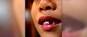 Treatment for crooked teeth