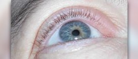 Treatment for eye infections