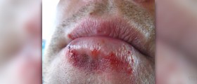 Treatment for oral herpes