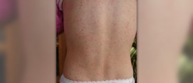 Treatment for scarlet fever