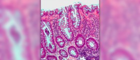 Treatment of sebaceous hyperplasia