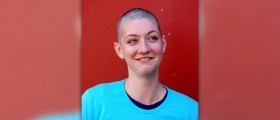 Treatment options for female pattern baldness