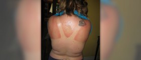 Treatments for sunburn